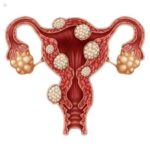 Miomas